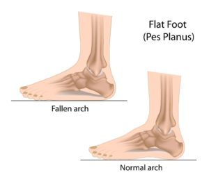 Flat Feet Fallen Arch Infographic
