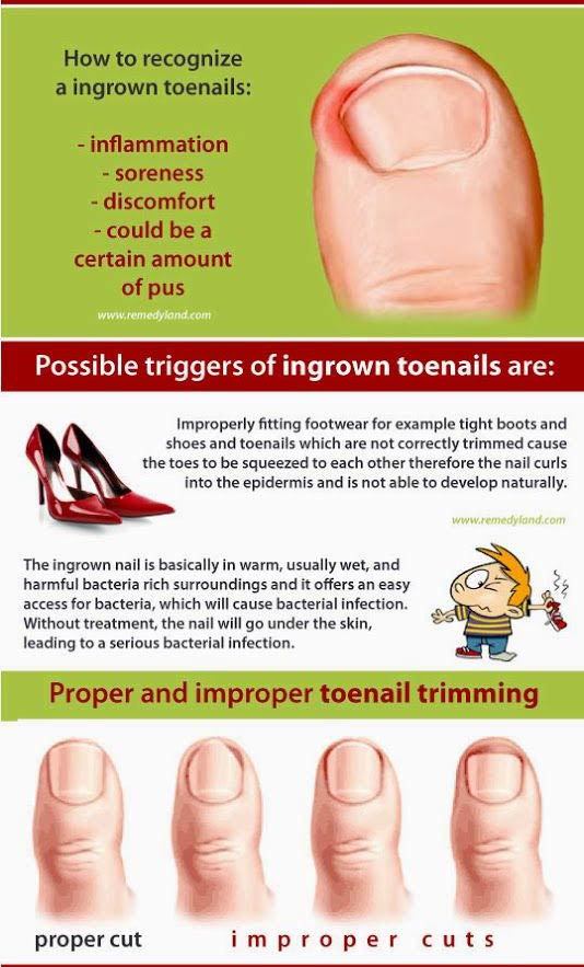 Home Remedies for an Ingrown Toenail - Complete Care
